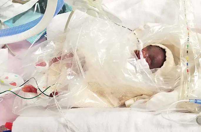 Adrial immediately after his birth. He is swaddled and there are IV tubes around him.