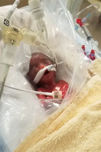 Adiah immediately after her birth. She is swaddled and wearing a breathing tube.