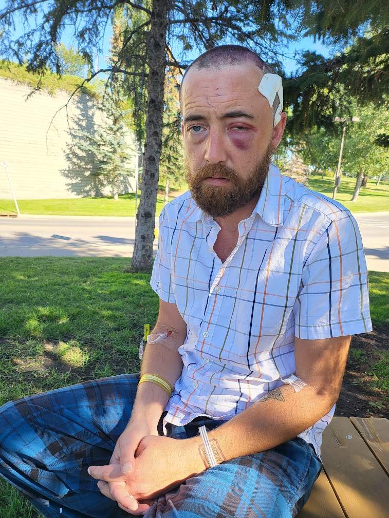 The aftermath of Brennon Dulle’s brain surgery.