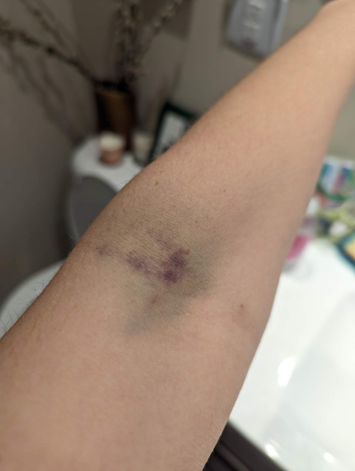 Julia Koziell’s arm following a recent blood draw