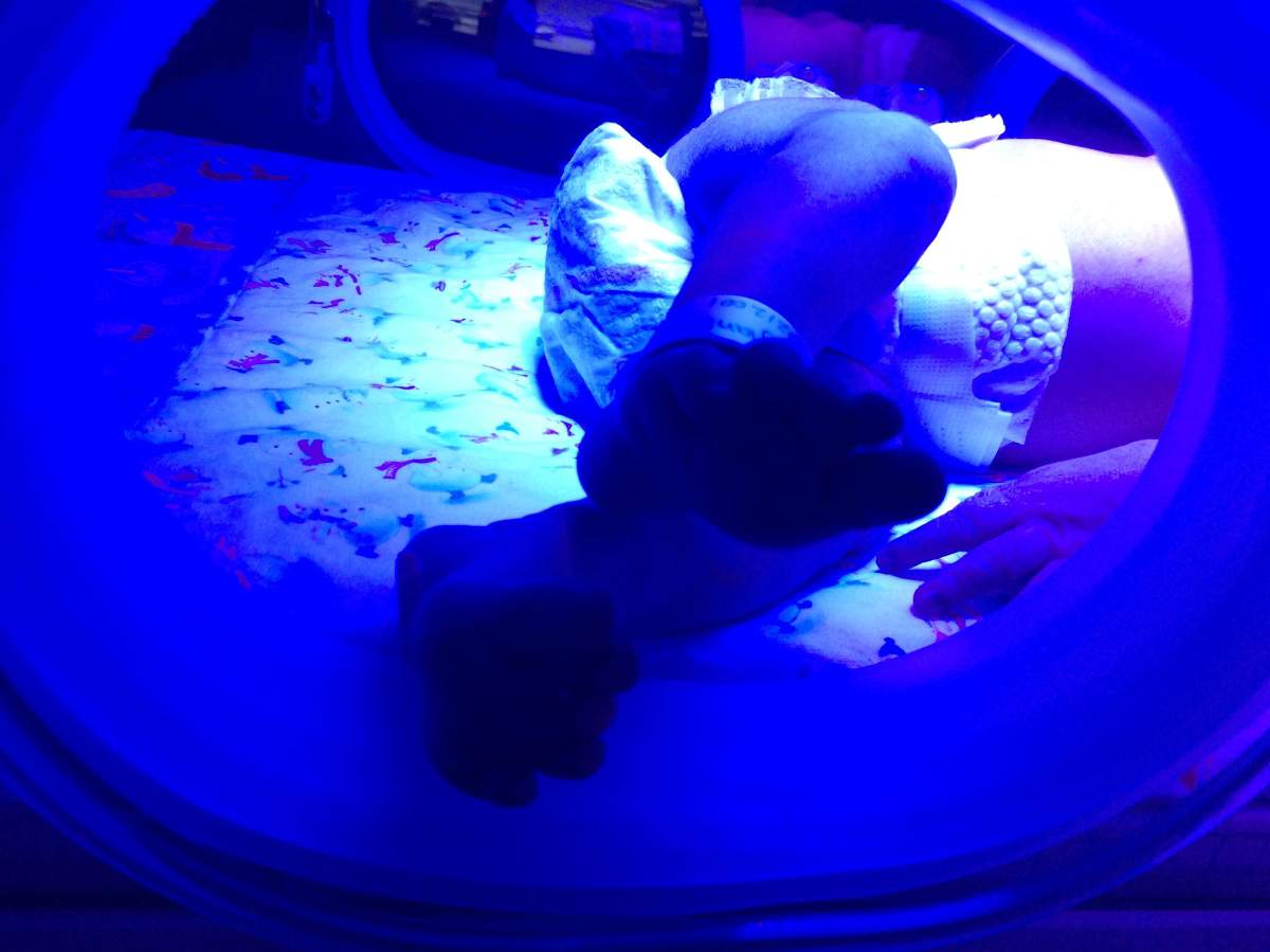 Babies with high bilirubin levels are often treated with light therapy.