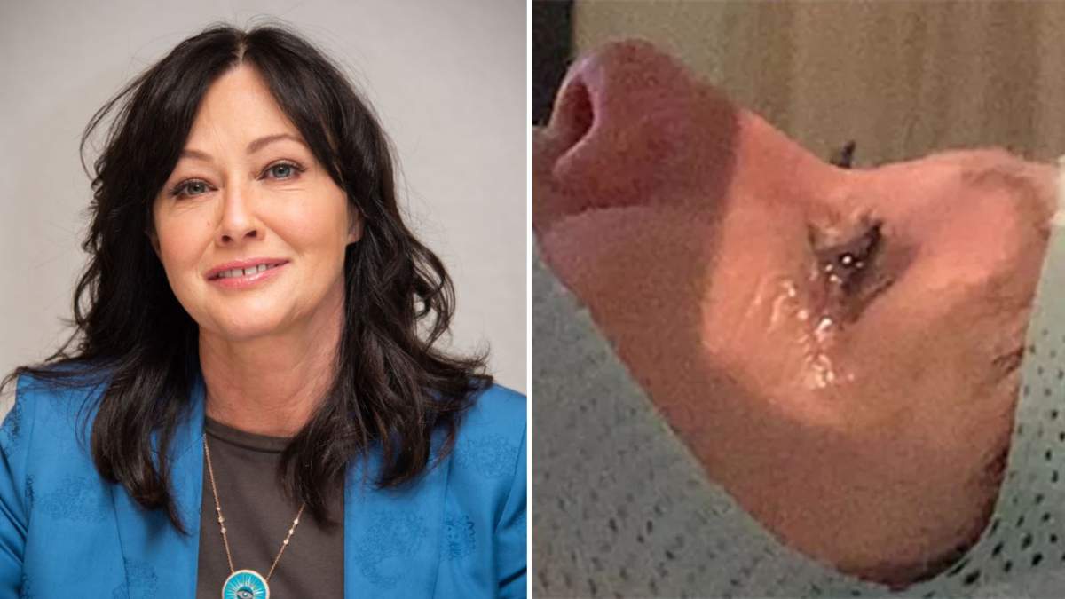 A split photo. On the left is Shannen Doherty. On the right is Shannen Doherty in a medical head and face mask. She is crying as she receives radiation therapy.