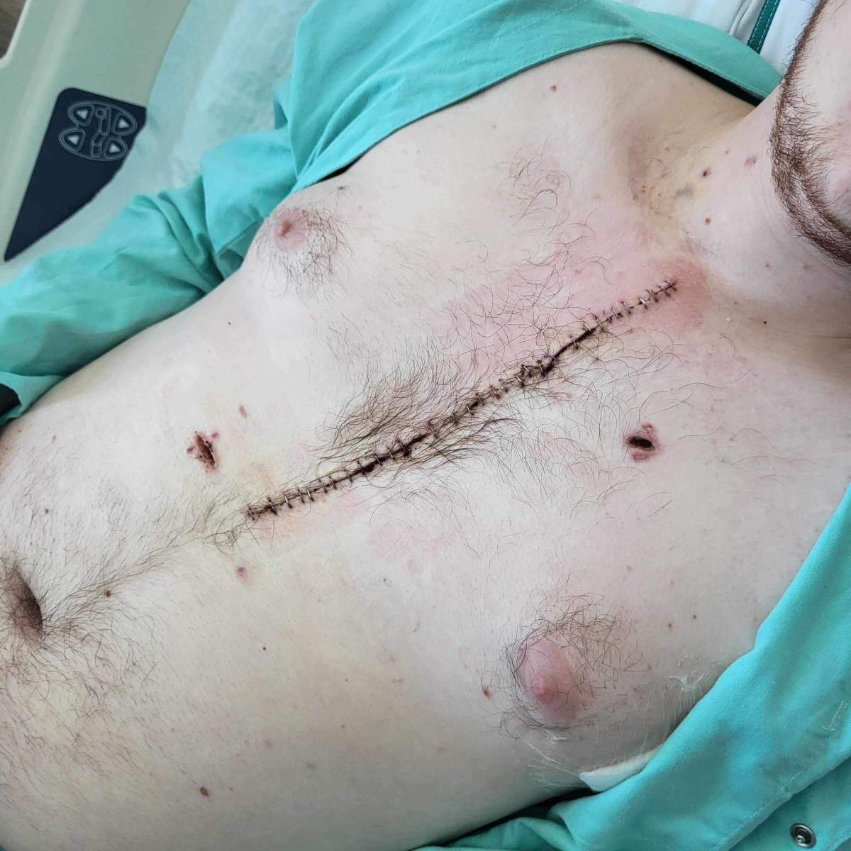 A scar on Colin Dube-Wheat’s chest from surgery after being stabbed in Campbell River earlier this month.