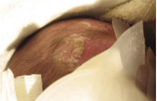 An infant with lesions on their scalp as the result of a sexually transmitted infection.
