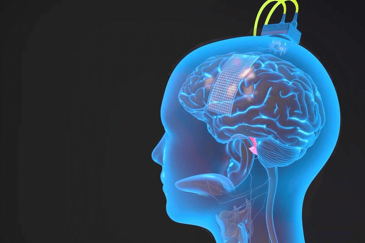 Animation of the brain implant Ann Johnson received that allows her to speak via a digital avatar.