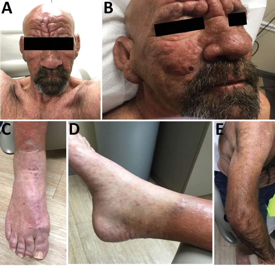 epromatous leprosy in a 54-year-old man in central Florida, USA, 2022. A, B) Leonine facies with waxy yellow papules. C) Violaceous nonblanching macules coalescing into patches along dorsum of feet bilaterally. D, E) Erythematous papules coalescing into plaques along extensor aspects of upper and lower extremities bilaterally.