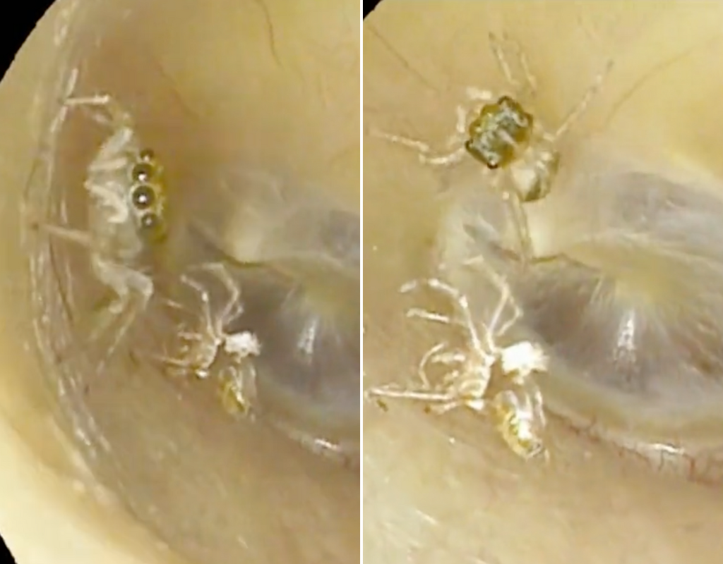 Screengrabs of a video published by the New England Journal of Medicine showing a tiny spider and its molted exoskeleton inside the ear canal of a 64-year-old woman from Taiwan.