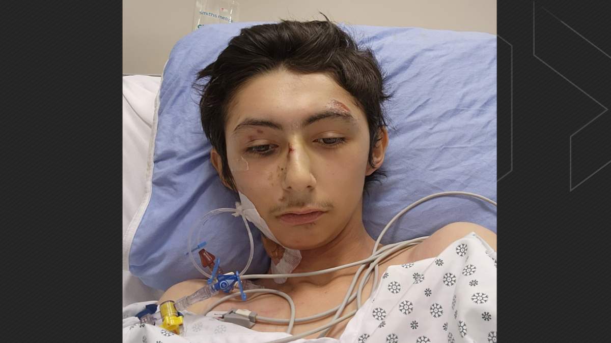Allan McCauley, 16, recovers at the Foothills Medical Centre after being struck by two vehicles along Memorial Drive on Nov. 17.