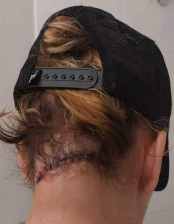 An image of the wounds a woman sustained during an unprompted machete attack in Vancouver on June 19, 2022.