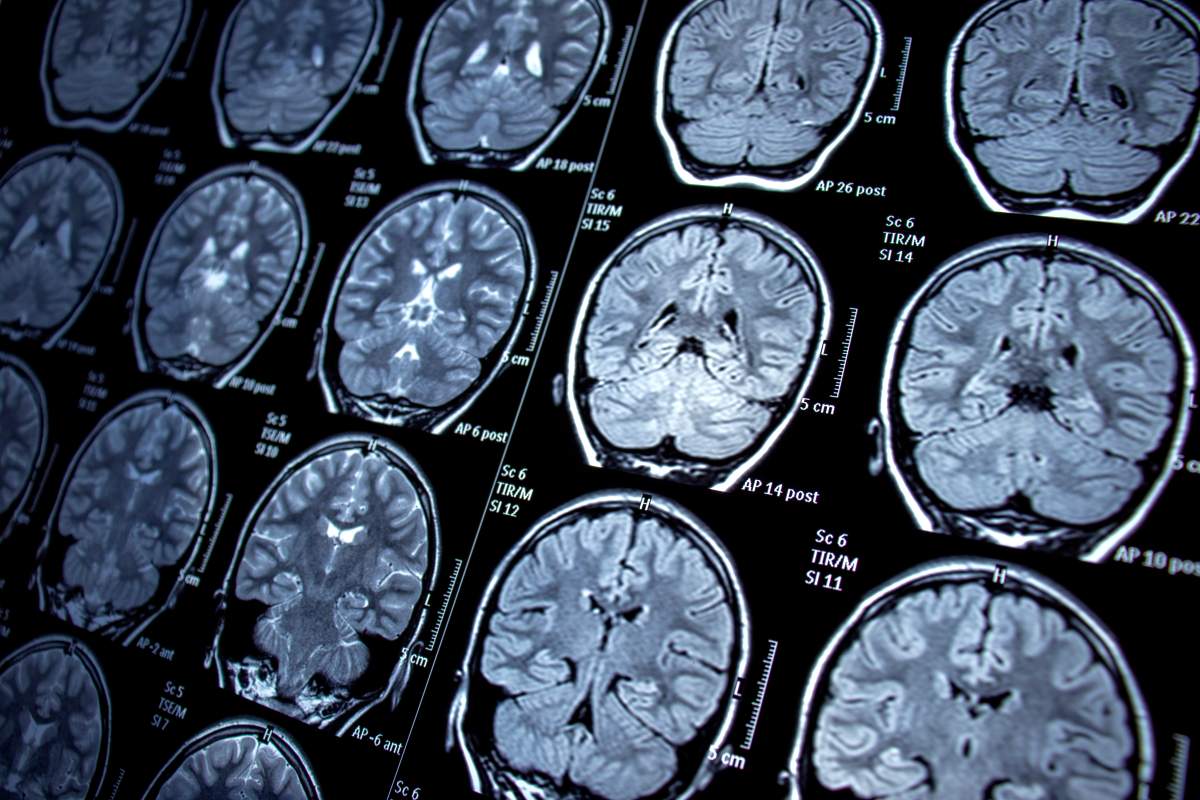 neurology, epilepsy, magnetic resonance imaging, mri, seizure, health