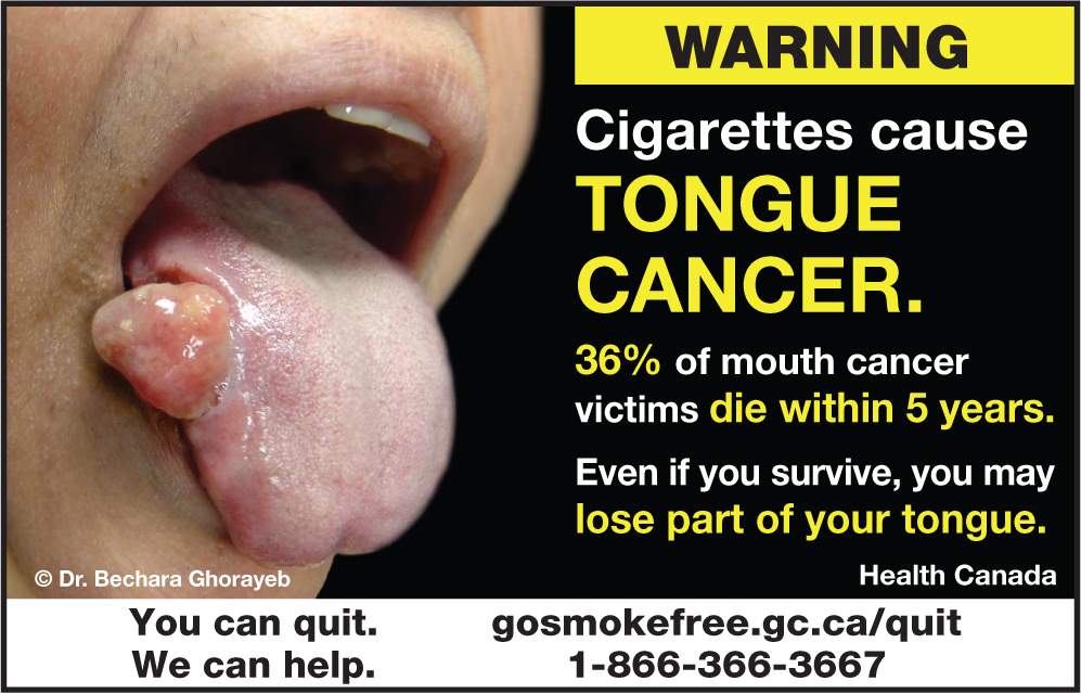 Cigarette packages in Canada are now showing a new set of graphic photos, for the first time since 2012, that link smoking with cancer as well as gangrene and various other diseases.