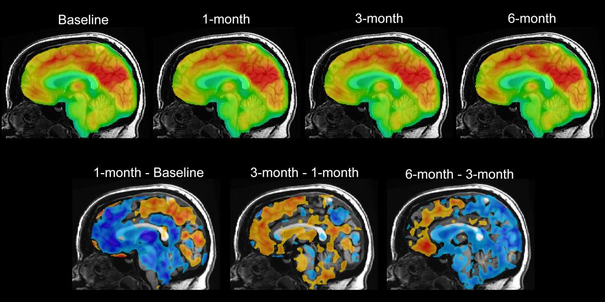 This series of PET brain scan images provided by Mount Sinai in 2024 shows changes in patient Emily Hollenbeck with deep brain stimulation therapy. Analyzing the brain activity of DBS patients, researchers found a unique pattern that reflects the recovery process. (Mount Sinai via AP)