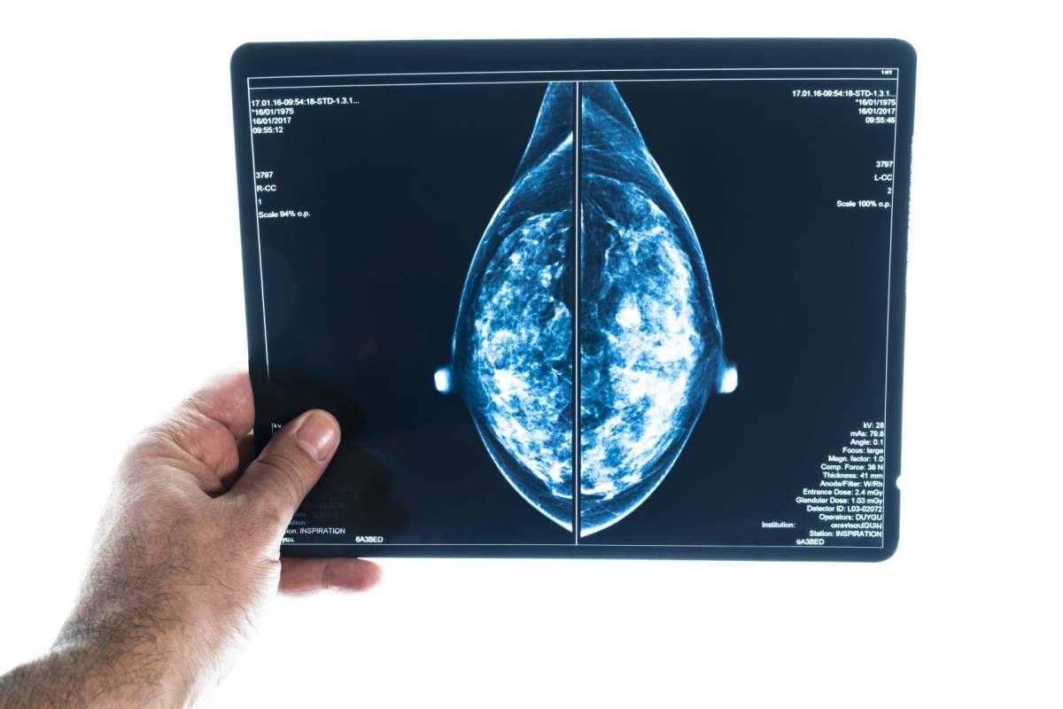 Breast cancer screening