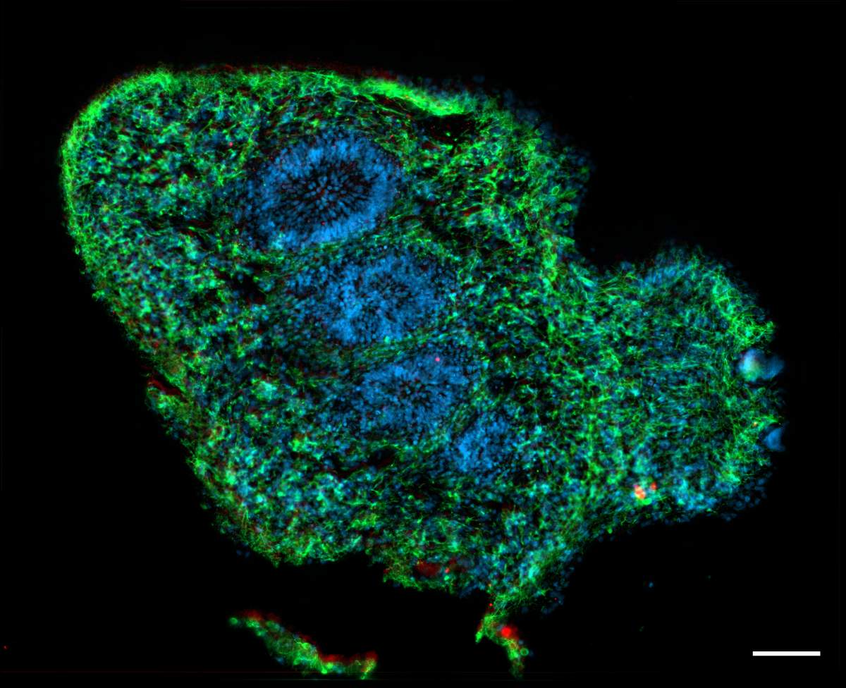 A loss of fine motor skills is a common symptom as the disease takes hold.