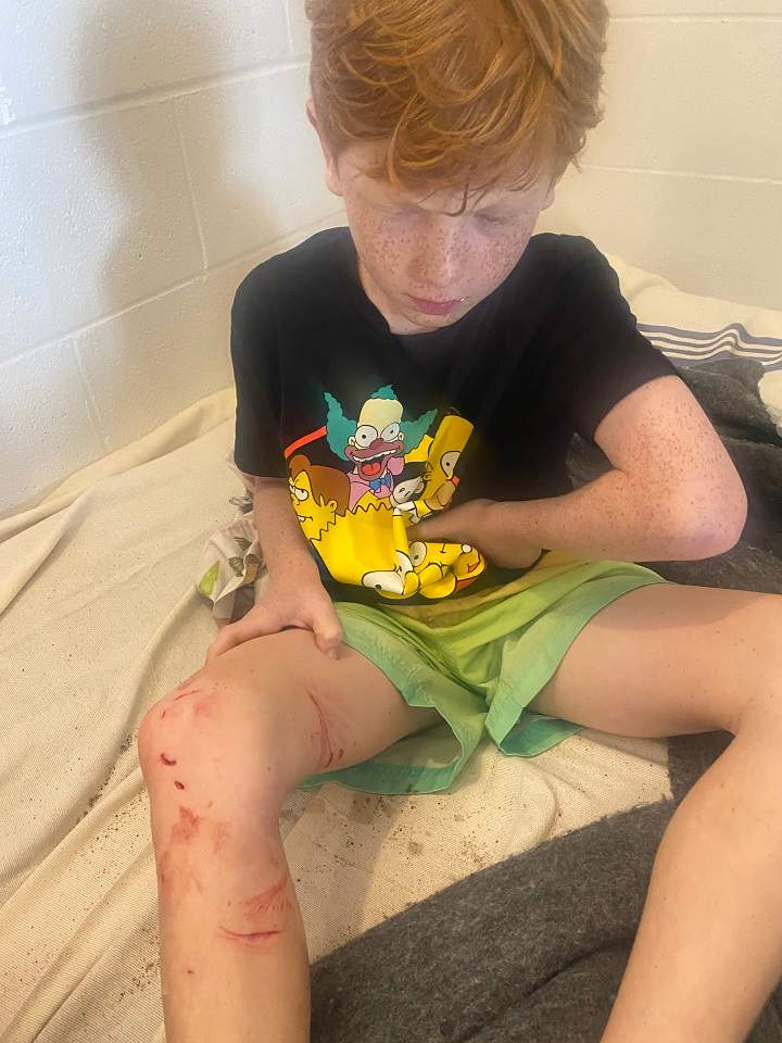 Max Mandl shows the injuries he sustained during a swim at Jean-Doré beach at the end of June 2024. Courtesy Mandl family