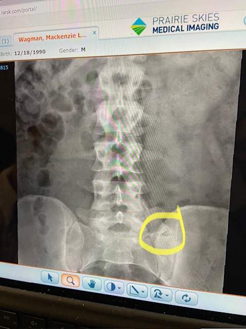 An x-ray of Mackenzie Wagman’s spine.