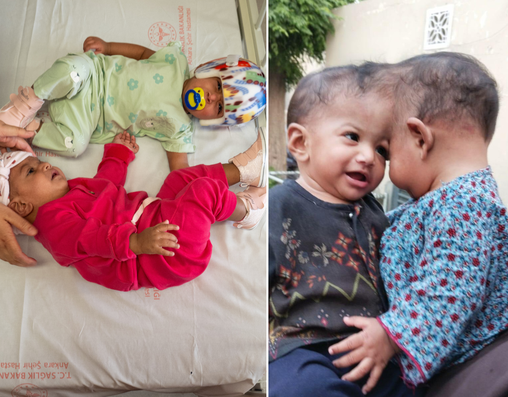 Mirha and Minal, 11-month-old girls from Pakistan, before and after the conjoined twins were separated in a two-stage operation.