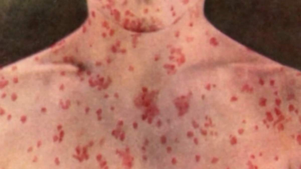Measles is a highly contagious disease characterized by the development of a red blotchy rash that appears 3 to 7 days after the fever starts, beginning on the ears and face before spreading to the rest of the body.