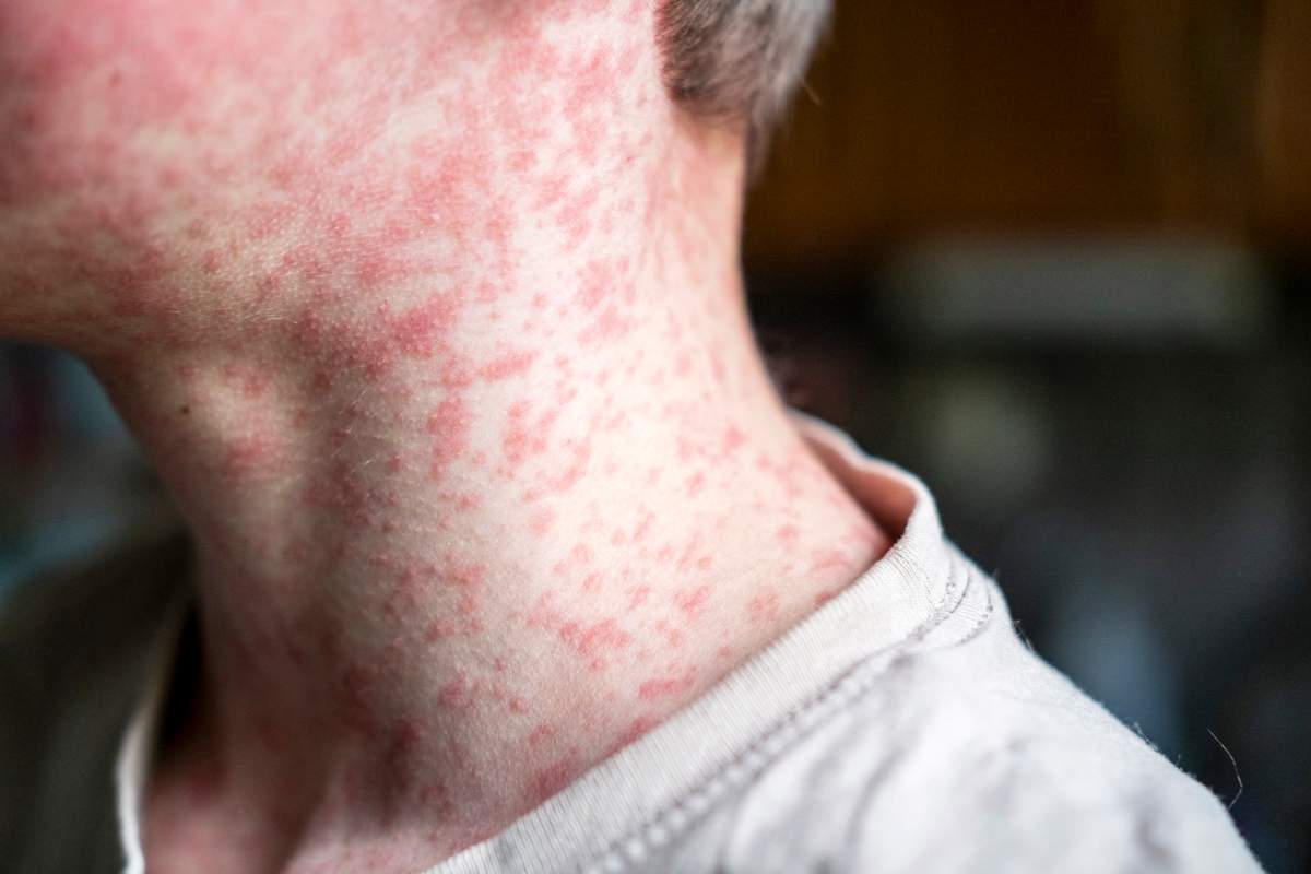 File photo of a person whose neck and face is covered with a measles rash.