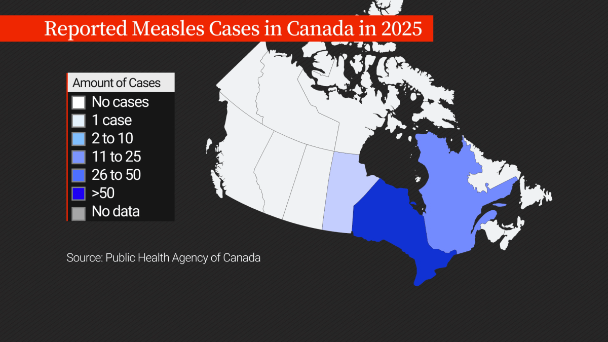 Measles is making a comeback in Canada. What’s driving the surge? - image