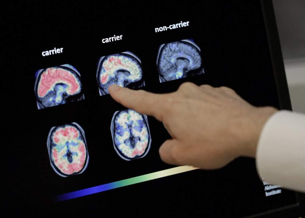 FILE - A doctor looks at PET brain scans at Banner Alzheimers Institute in Phoenix on Aug. 14, 2018.
