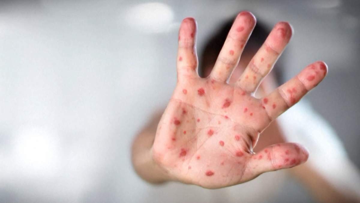 Alberta health officials warn anyone who was born in 1970 or had fewer than two doses of the measels vaccine, is at risk of contracting the highly contagious virus.