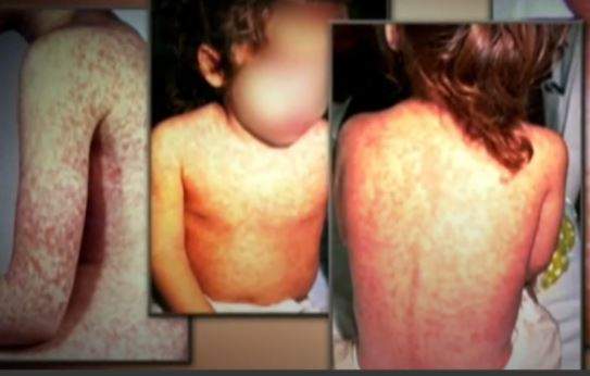 The symptoms of mesles include a fever of 38.3 C or higher, a cough, runny nose, red eyes and a rash that appears 3 to 7 days after the fever starts, usually beginning behind the ears and spreading down the body to the arms and legs.