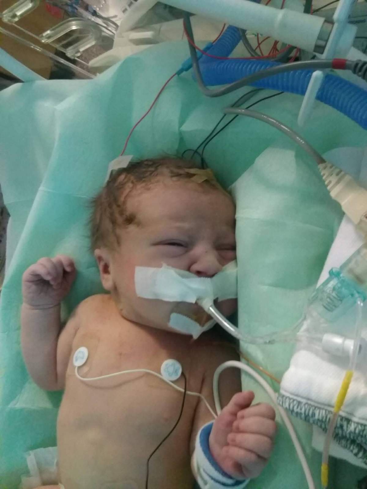 Baby hooked up to equipment in NICU