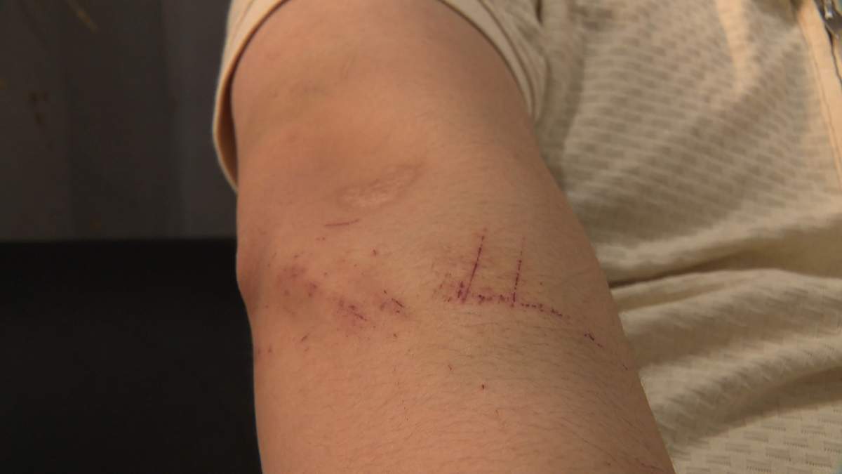 A Calgary man shows off some of the injuries he alleges he suffered during an encounter with two teens who attempted to steal a laptop from him when a Facebook Marketplace sale turned violent.