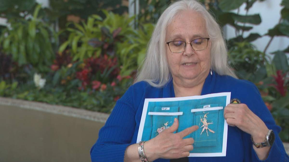Deborah Hoekstra shows off the scar tissue doctors removed from her lungs.