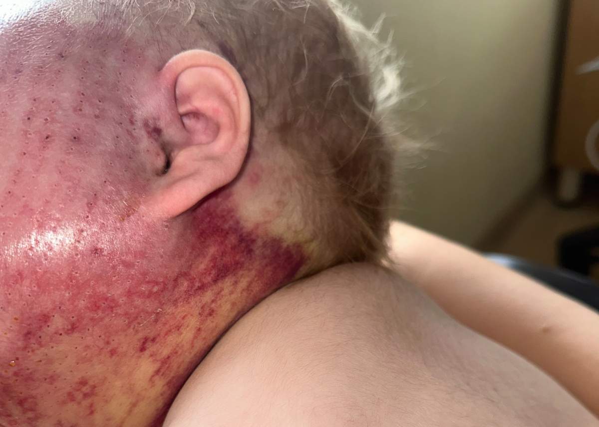 The treatment Myla underwent in Italy is called modified ElectroScleroTherapy, or MEST for short and it uses a combination of strong medication and electrical pulses to target the malformed cells.