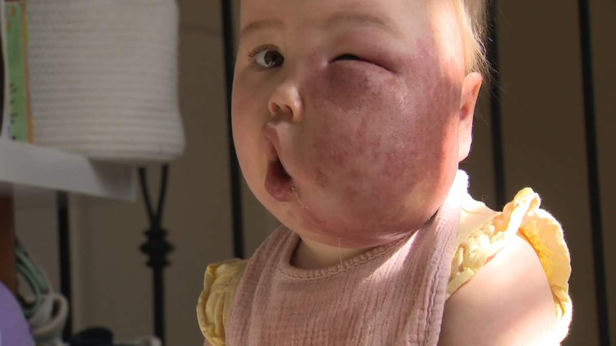 Two-year-old Myla Lieskovsky suffers from a rare genetic disorder called capillary malformation-arteriovenous malformation syndrome.