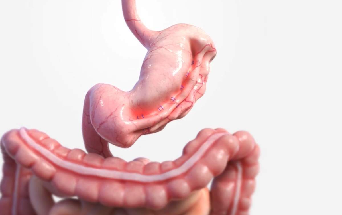 During a endoscopic sleeve gastroplasty (ESG), part of a patient's stomach is stitched up from the inside via a tube down the throat, making the organ smaller without incisions.