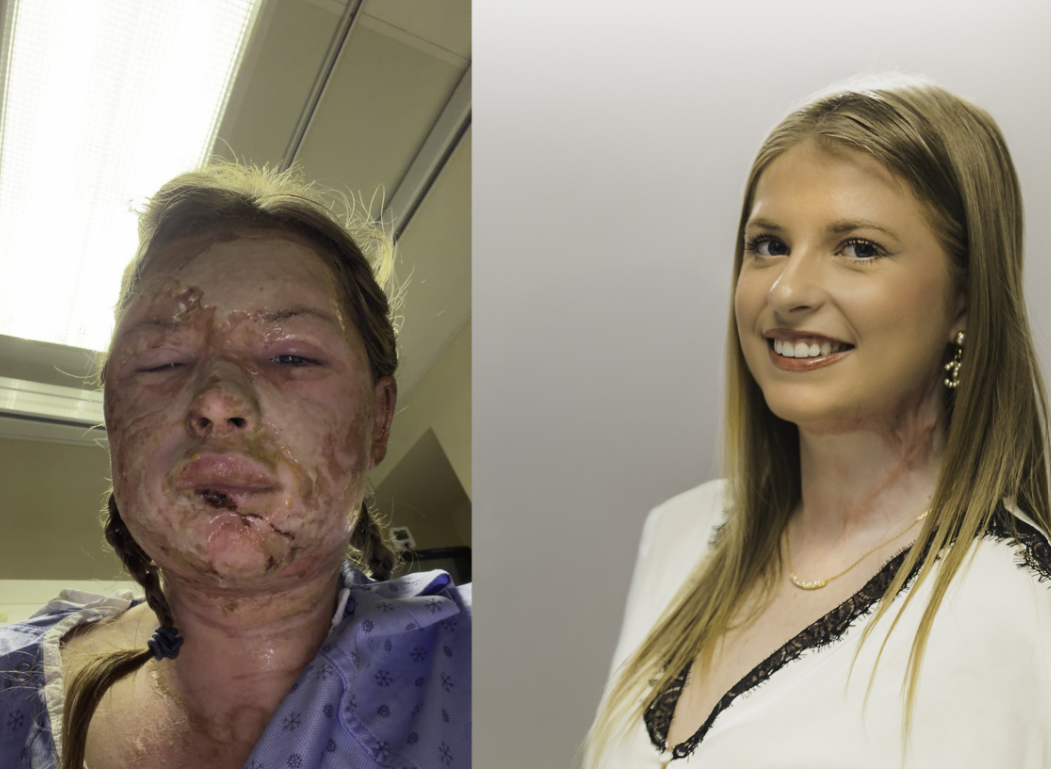 Hamilton Health Sciences said its team used exosomes to treat an 18-year-old Western University student after a fire in London, Ont., last December.
