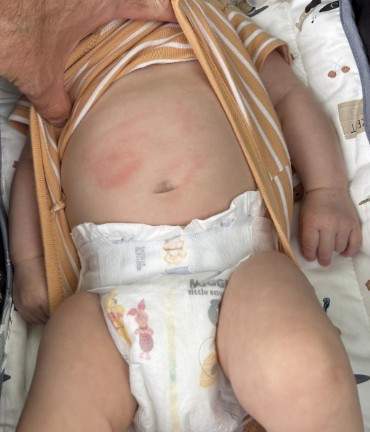 This photo provided by Calgary police shows the bruising left on a 9-week-old baby after he was assaulted by a youth while out for a walk in a stroller with his father on June 15.