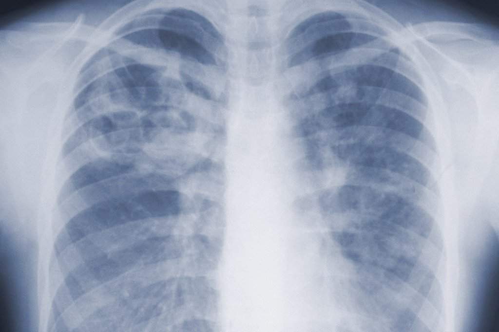 X-ray