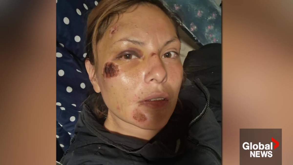ASIRT looking into Edmonton woman’s allegation of unprovoked police assault: ‘Smashed my face’ - image